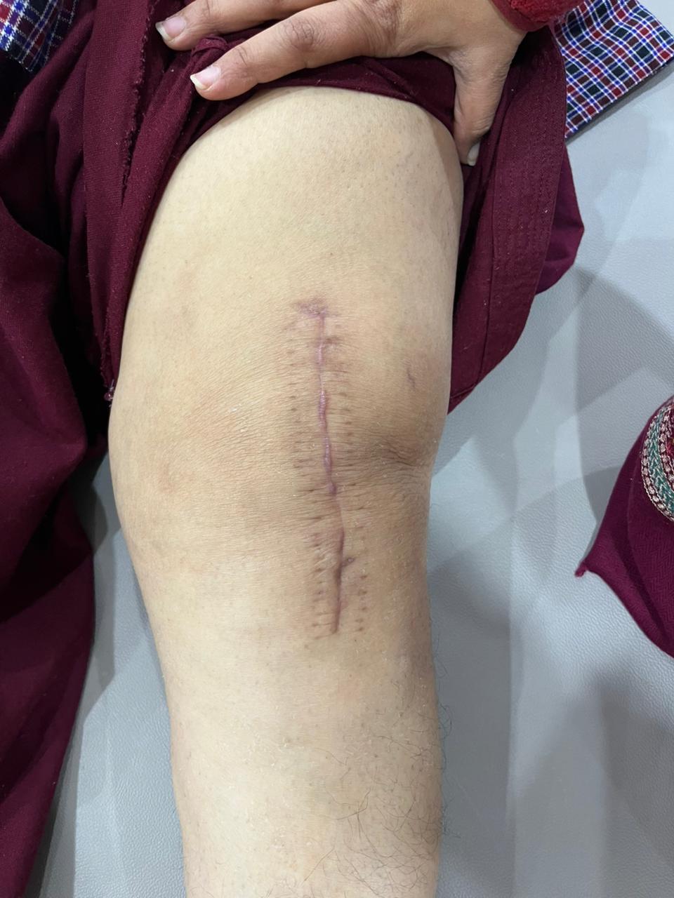 How Many Physiotherapy Sessions After Knee Replacement?